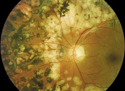 Ophthalmologists Vital in Mitigating Systemic Risks for Patients With Diabetic Retinopathy - Neurology Advisor